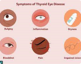 Teprotumumab for Asymmetric Thyroid Eye Disease